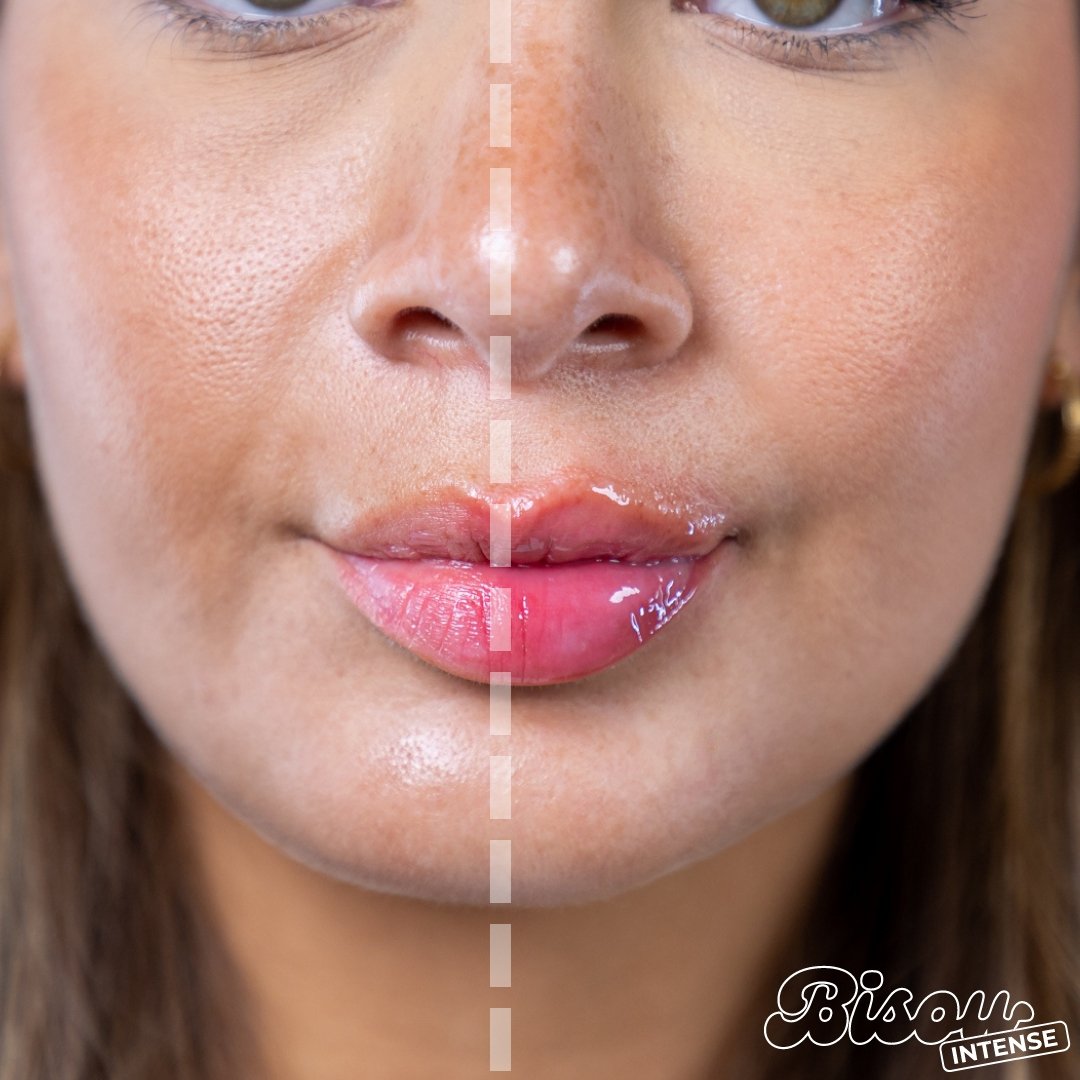 Bisou™ Instant Lip Pumper - Bisou